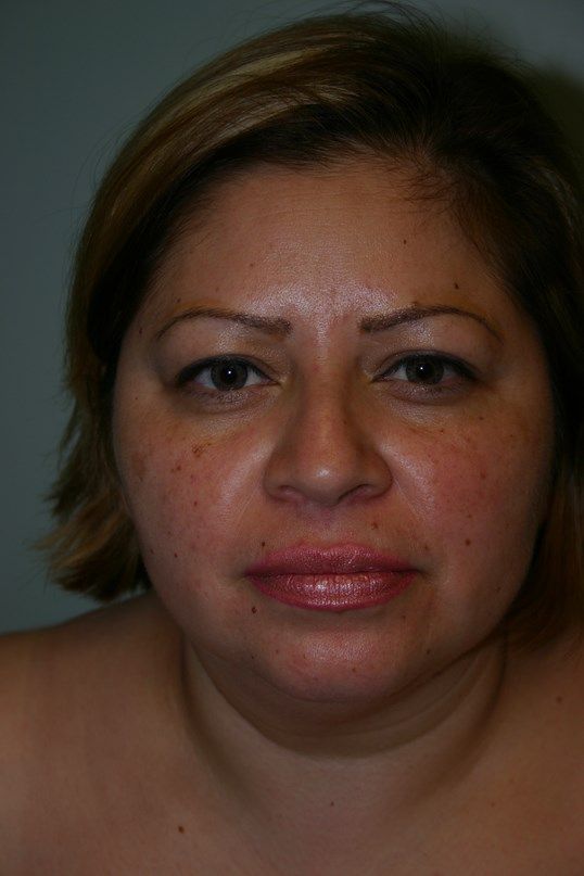 Rhinoplasty Before & After