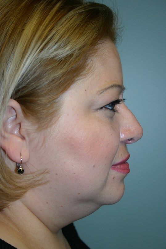Rhinoplasty Before & After
