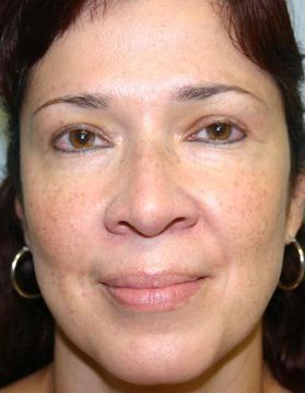 Rhinoplasty Before & After