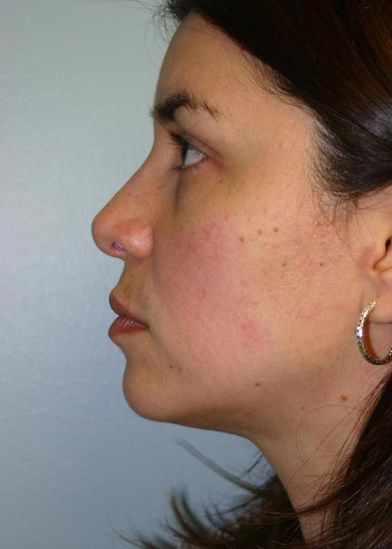 Rhinoplasty Before & After