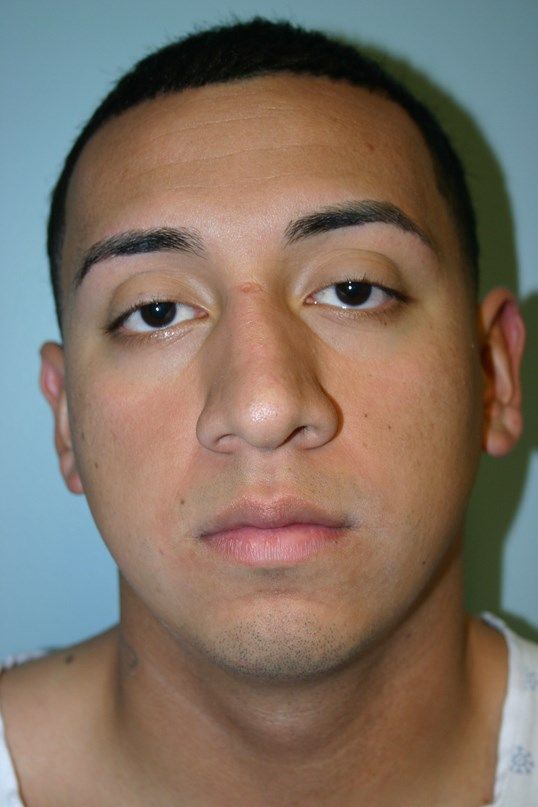 Rhinoplasty Before & After