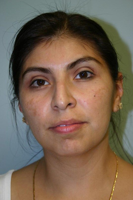 Rhinoplasty Before & After