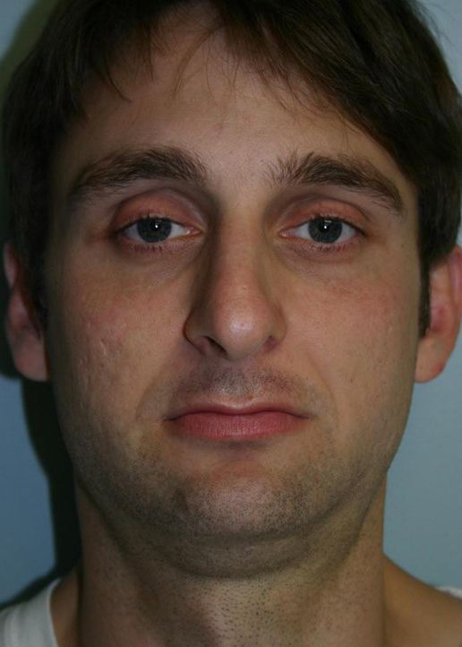 Rhinoplasty Before & After