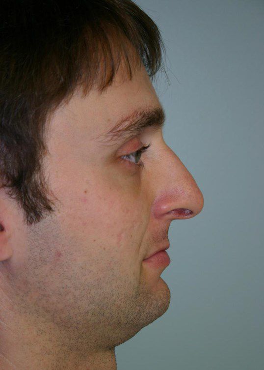 Rhinoplasty Before & After