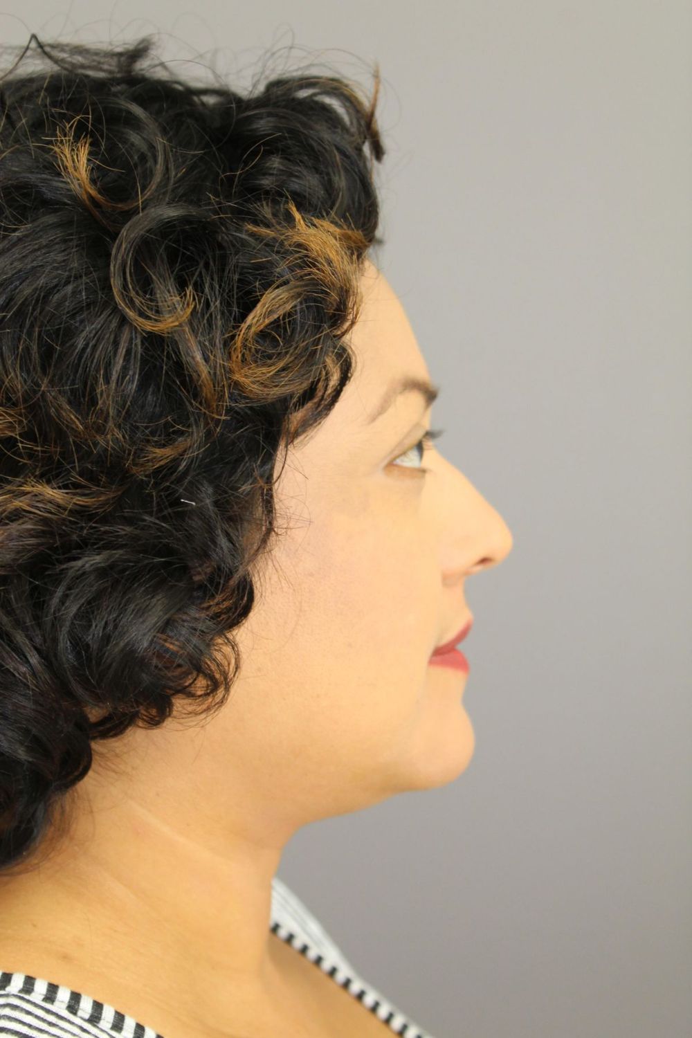 Rhinoplasty Before & After