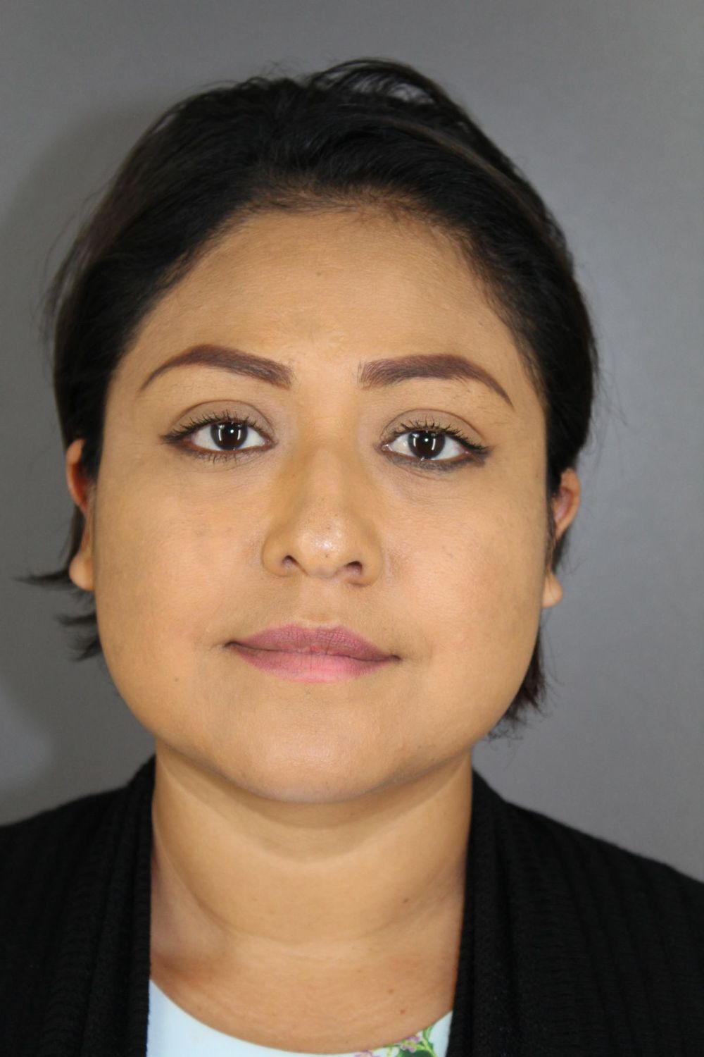 Rhinoplasty Before & After