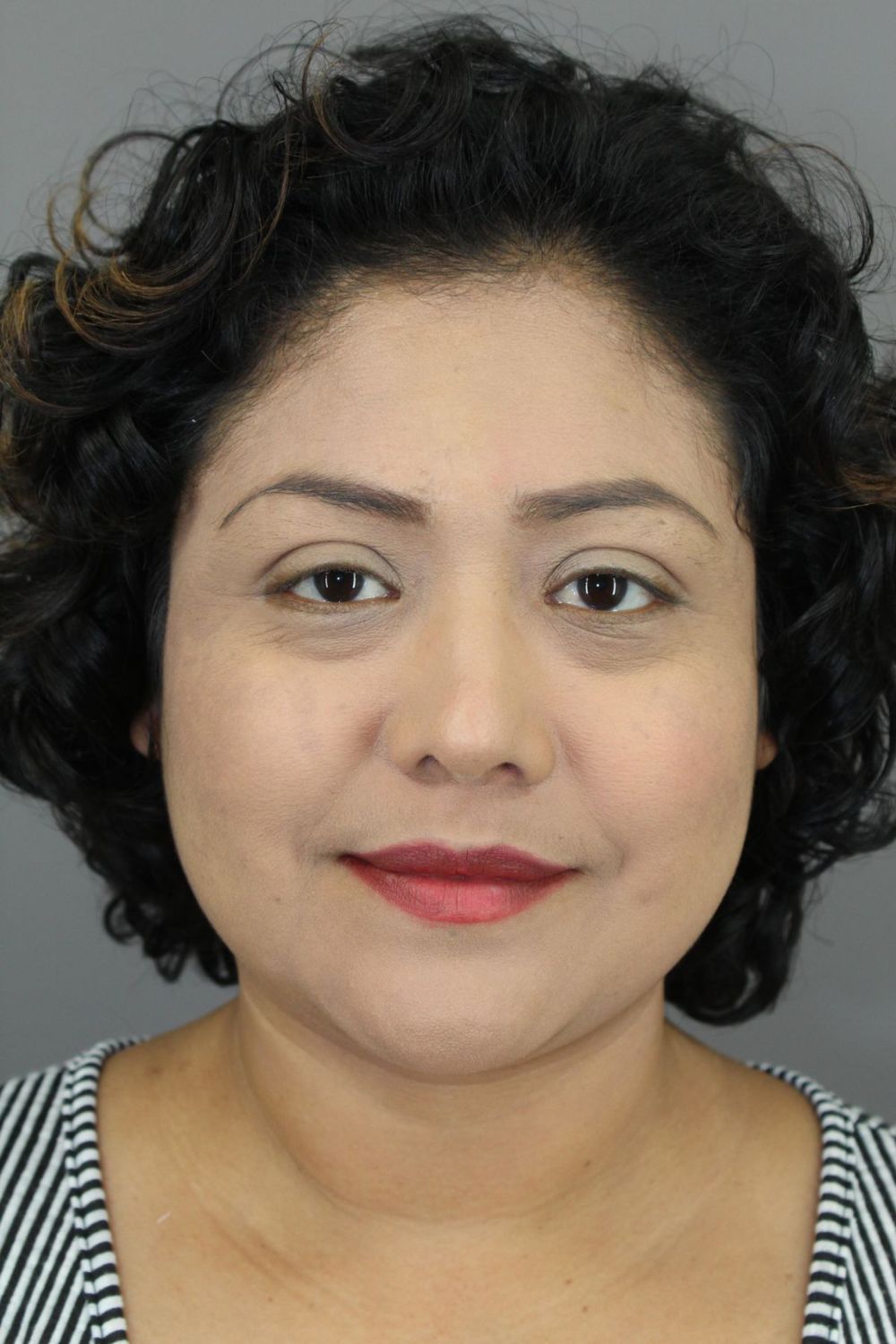 Rhinoplasty Before & After