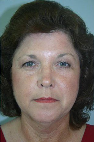 Juvederm Before & After