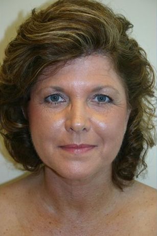 Juvederm Before & After