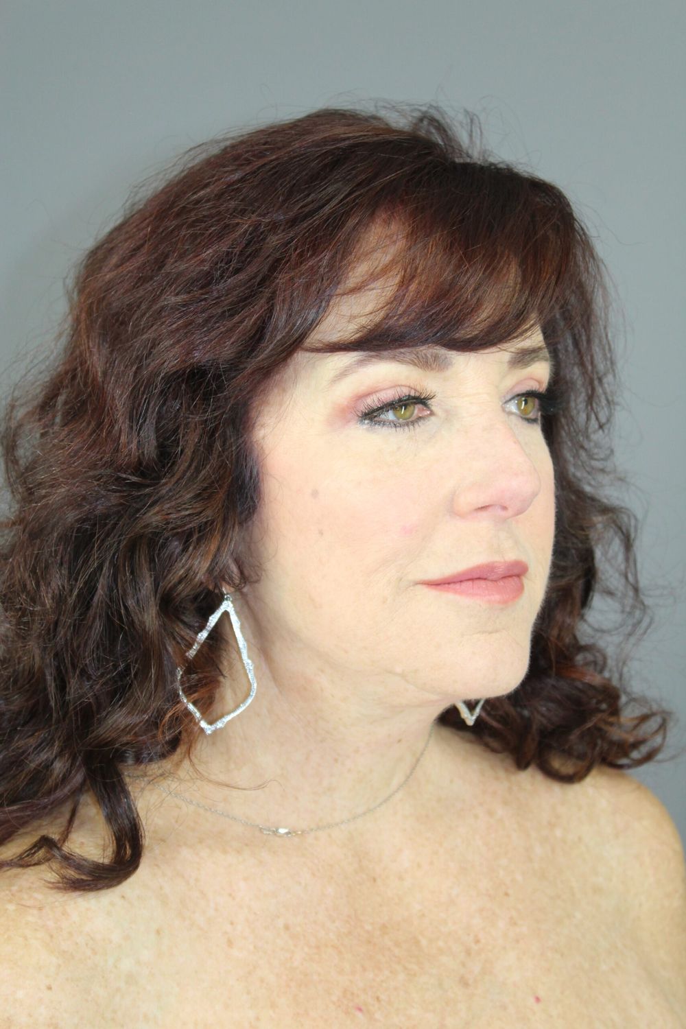 Juvederm Before & After