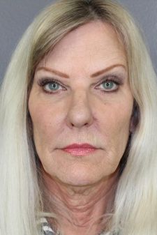 Juvederm Before & After