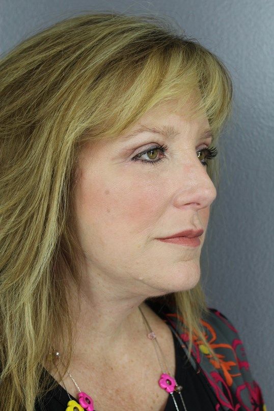 Juvederm Before & After