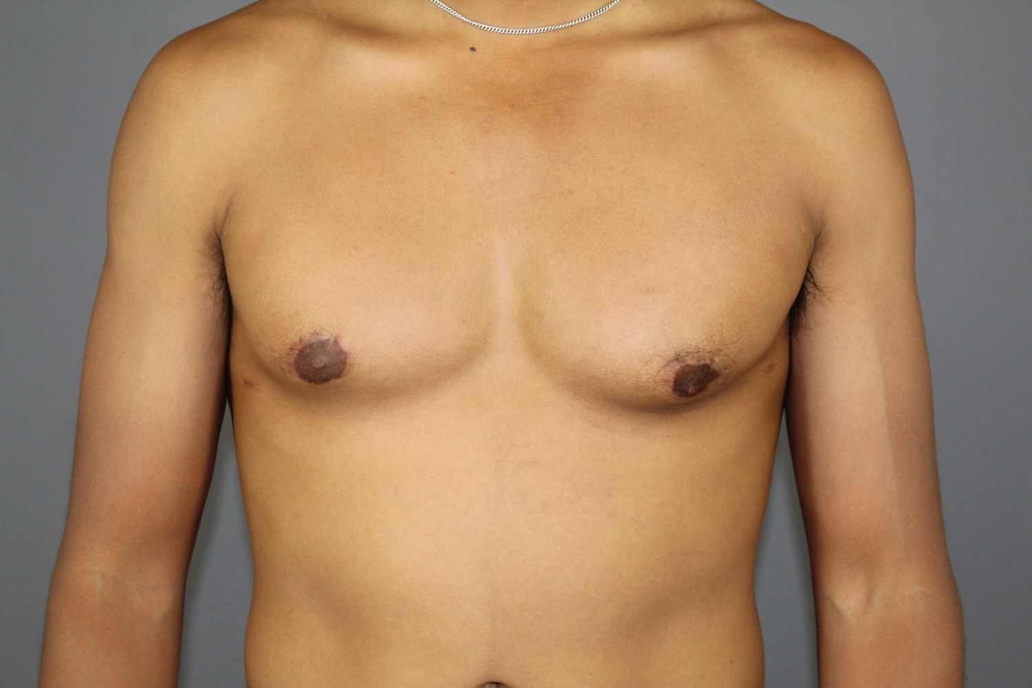 Gynecomastia Before & After