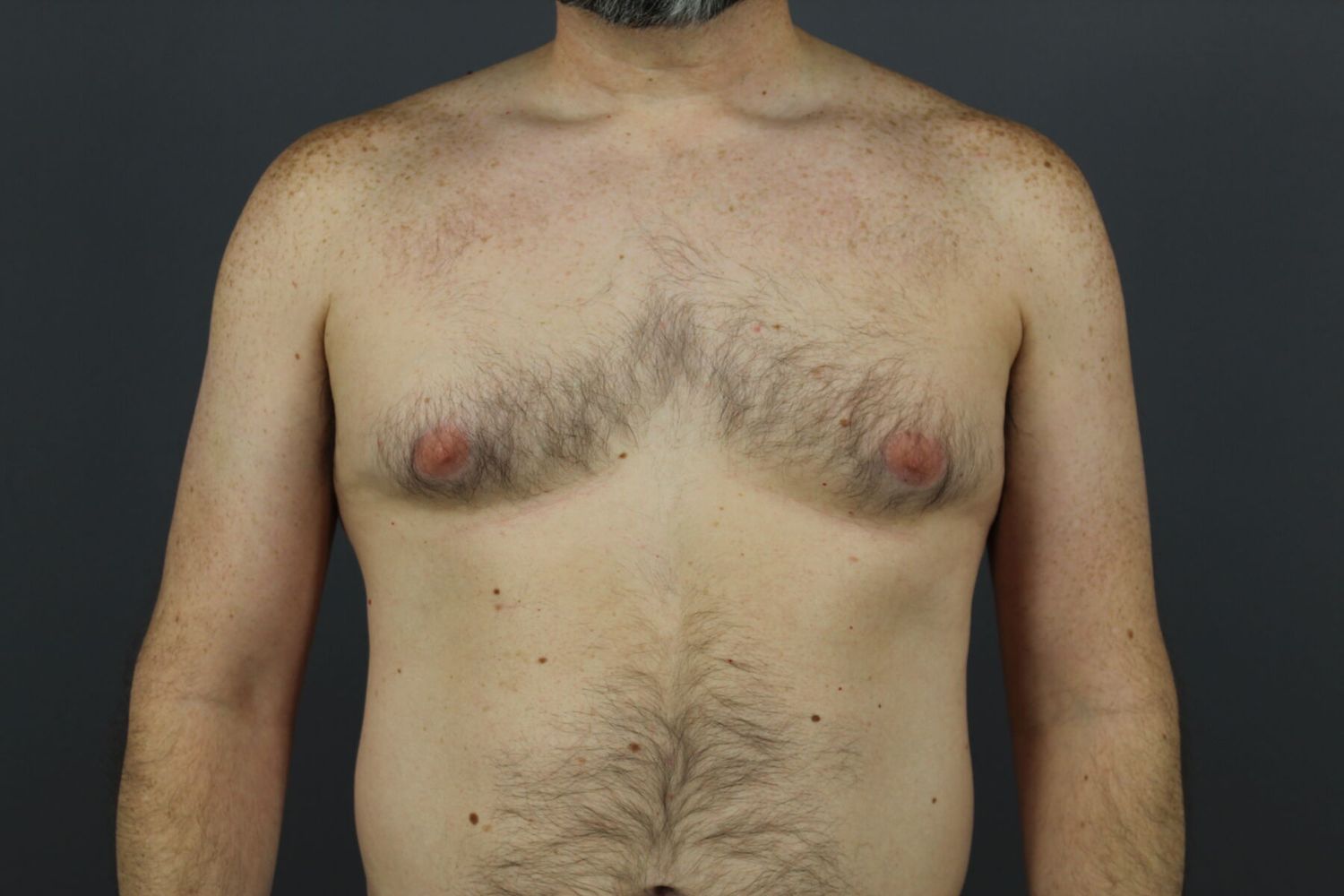 Gynecomastia Before & After