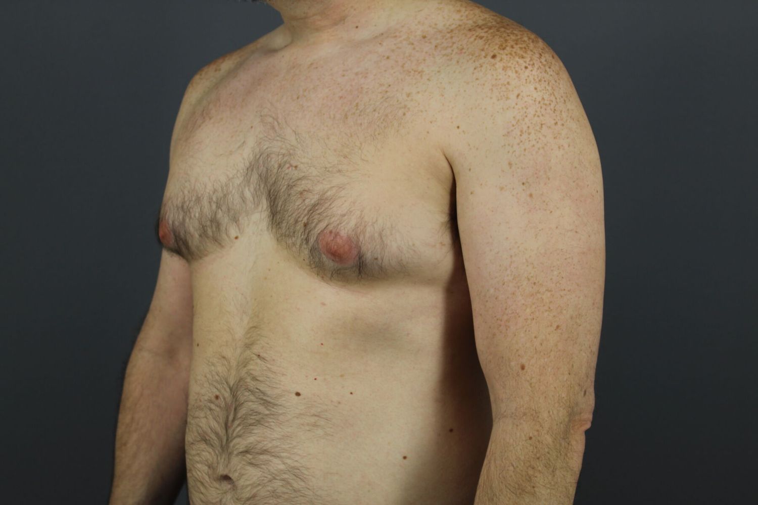 Gynecomastia Before & After