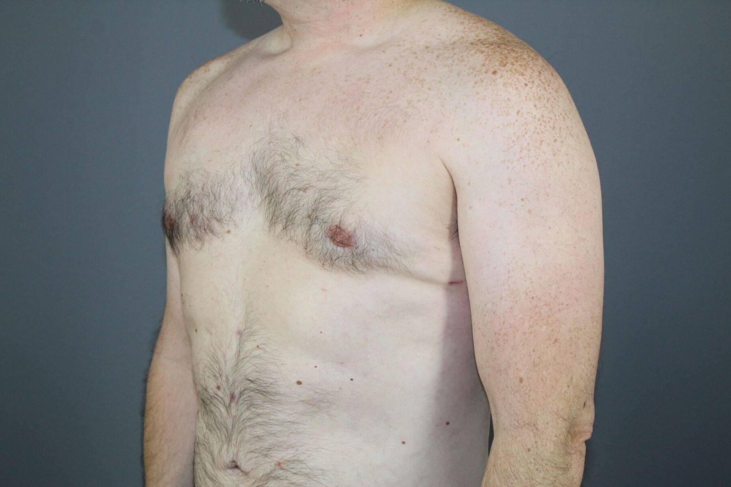 Gynecomastia Before & After