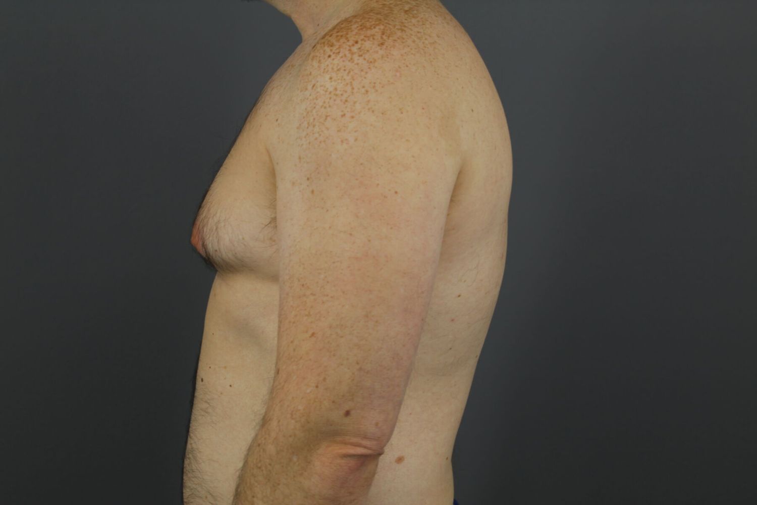 Gynecomastia Before & After