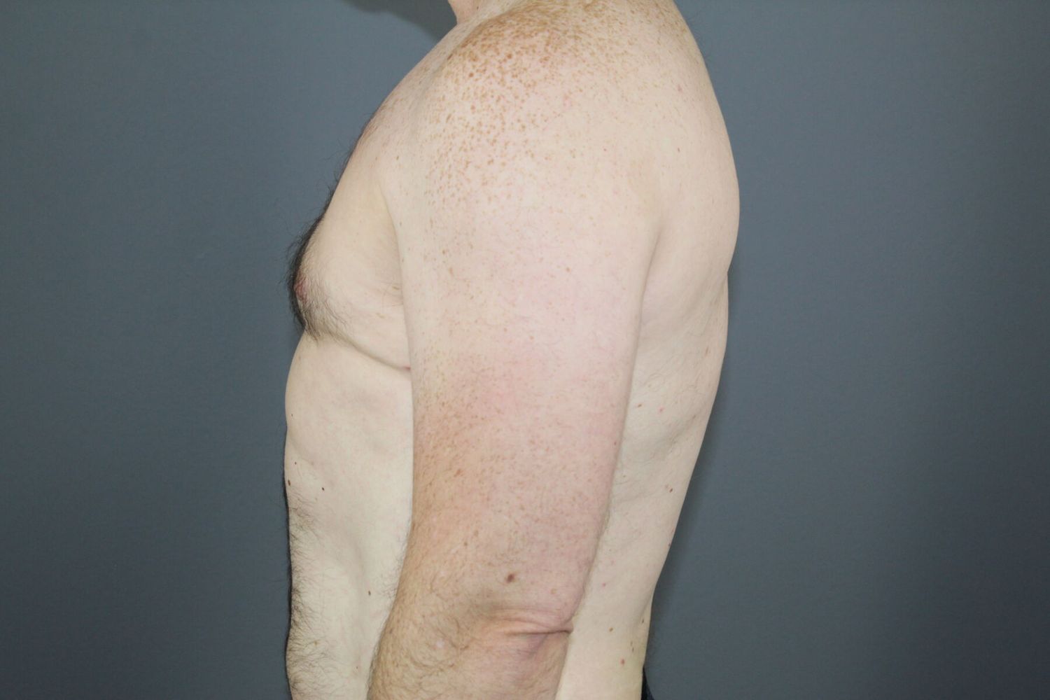 Gynecomastia Before & After