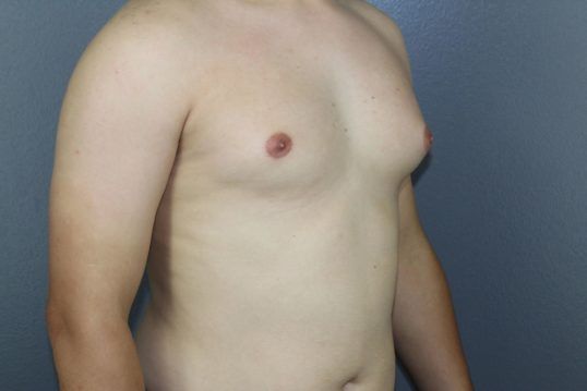 Gynecomastia Before & After