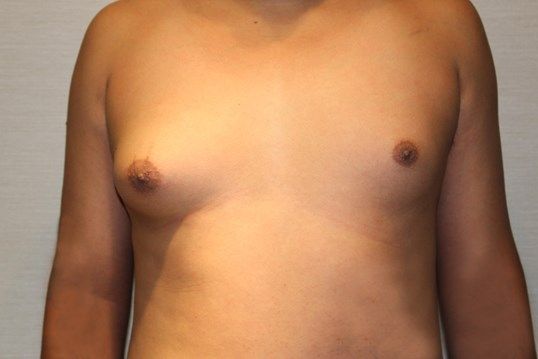 Gynecomastia Before & After
