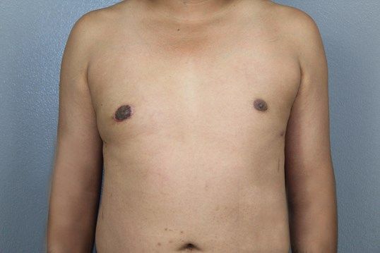 Gynecomastia Before & After