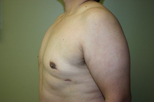 Gynecomastia Before & After