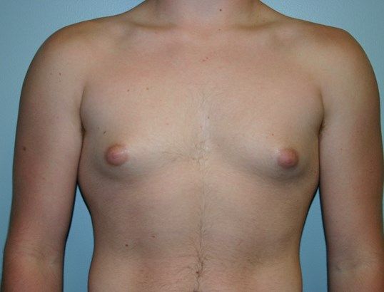 Gynecomastia Before & After