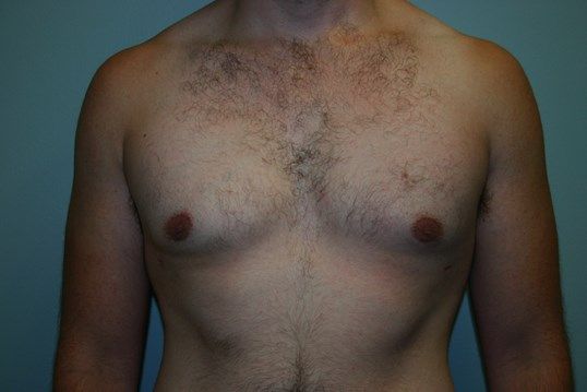 Gynecomastia Before & After