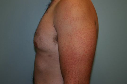 Gynecomastia Before & After