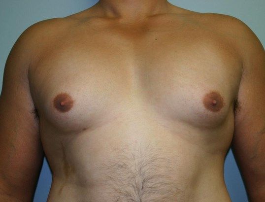 Gynecomastia Before & After