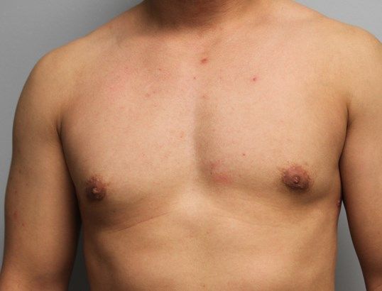 Gynecomastia Before & After