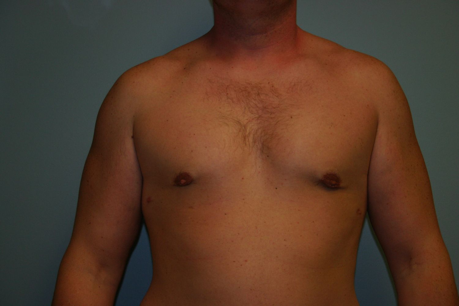 Gynecomastia Before & After