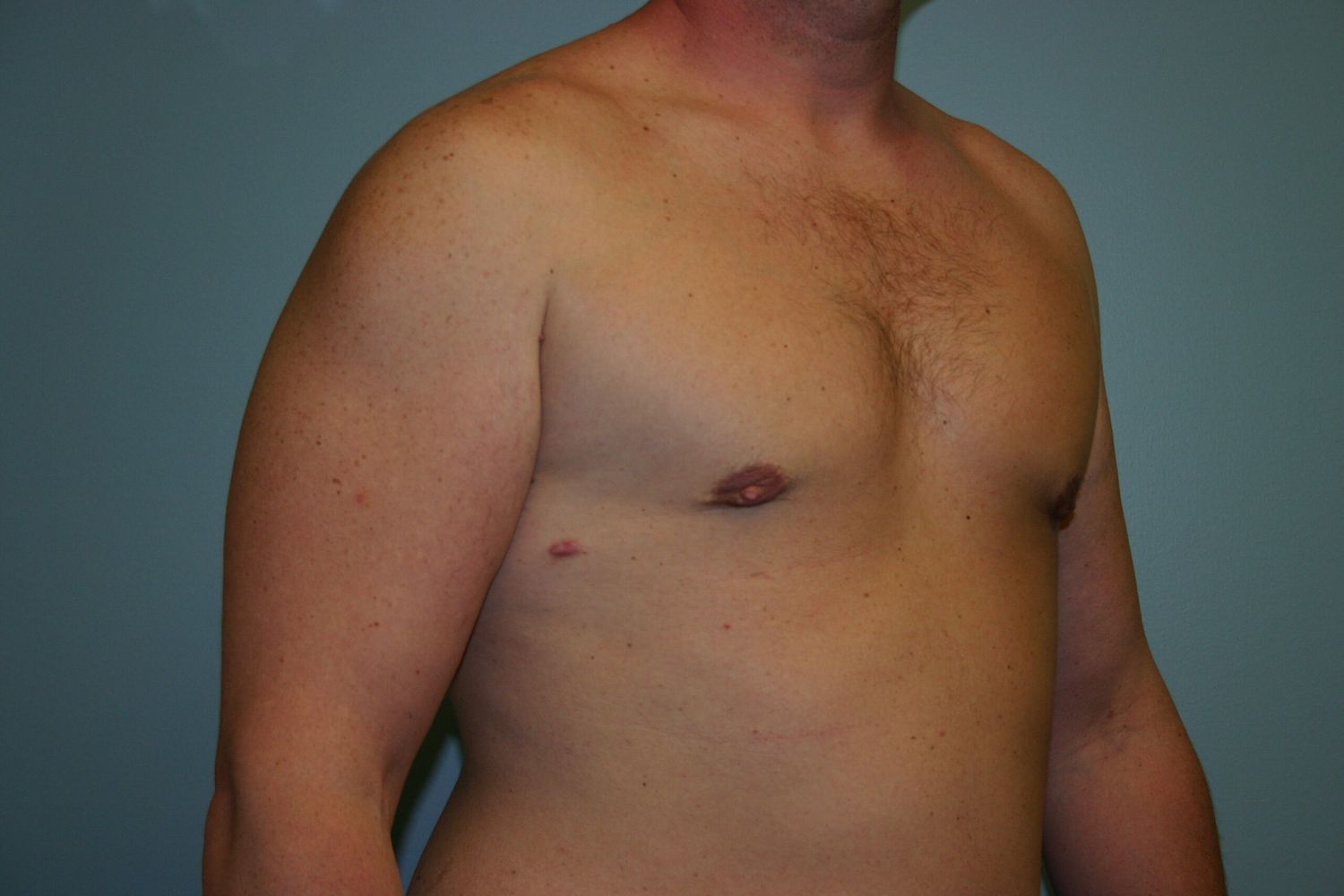 Gynecomastia Before & After