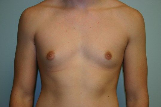 Gynecomastia Before & After