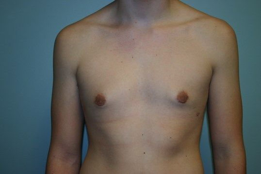 Gynecomastia Before & After