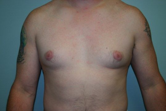 Gynecomastia Before & After