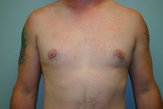 Gynecomastia Before & After