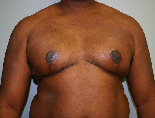 Gynecomastia Before & After