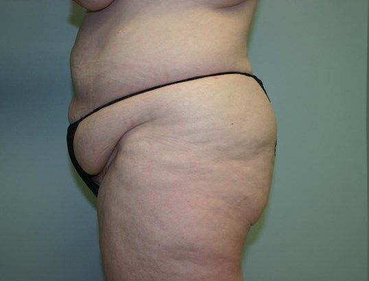 Mommy Makeover Before & After