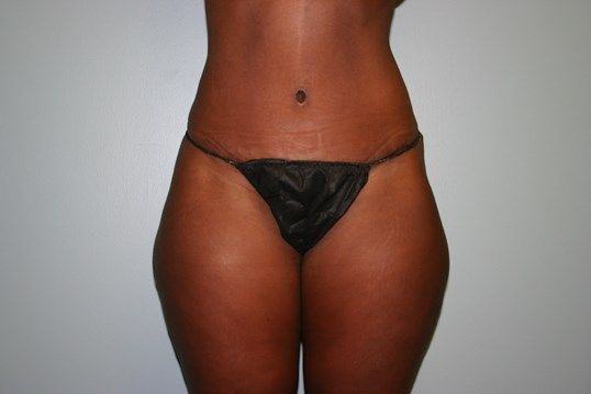 Mommy Makeover Before & After