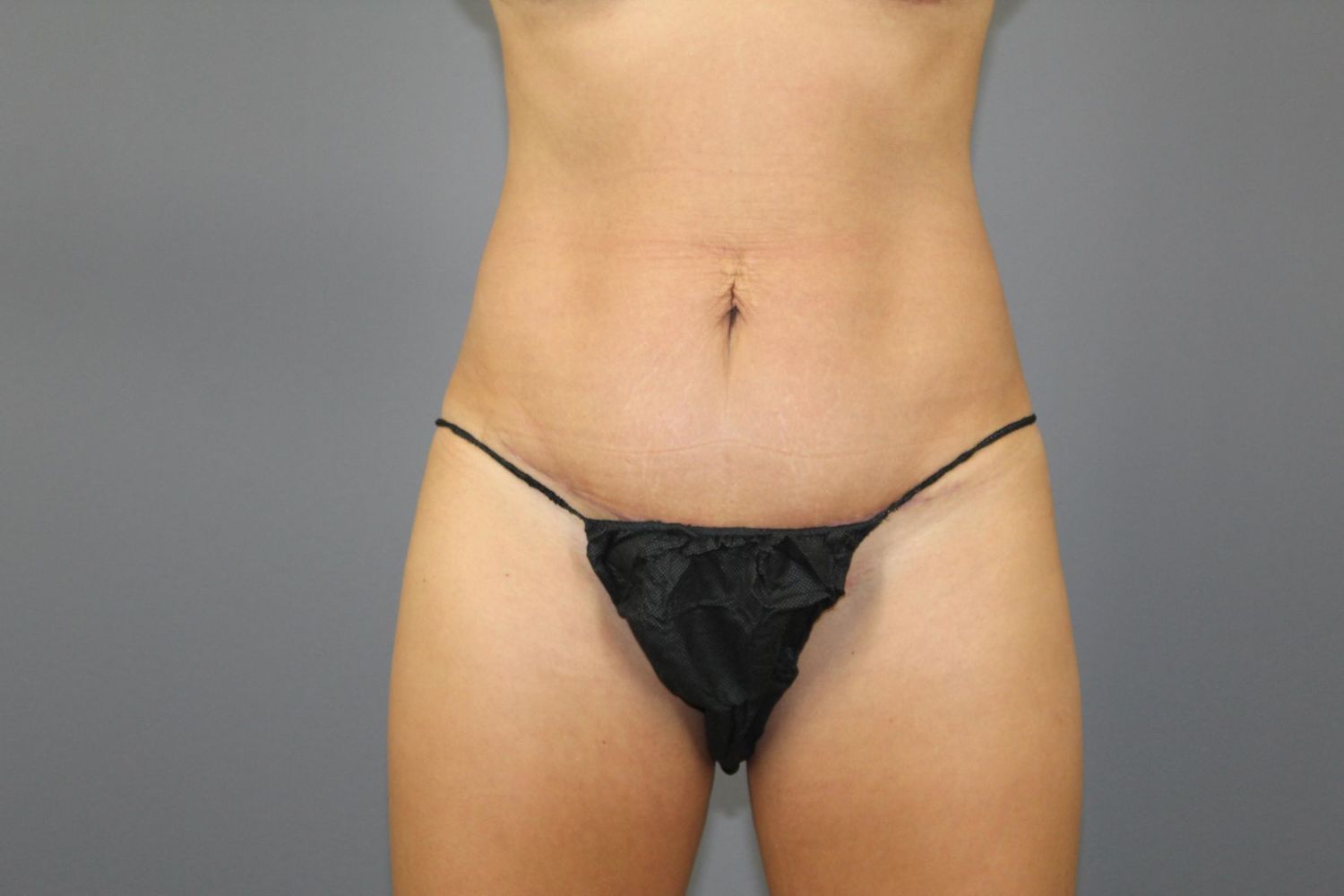 Mini Tummy Tuck Before & After