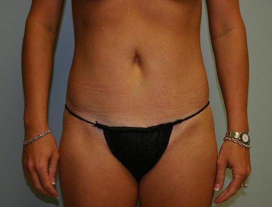 Mini Tummy Tuck Before & After