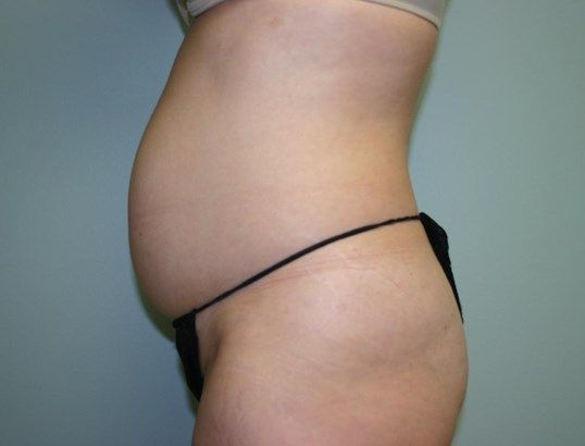 Mini Tummy Tuck Before & After