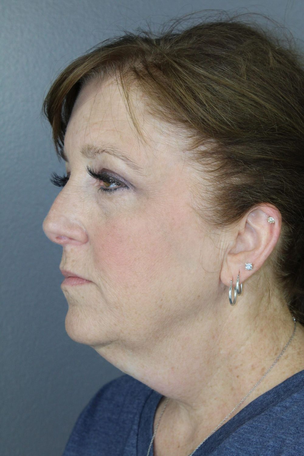 Botox Before & After