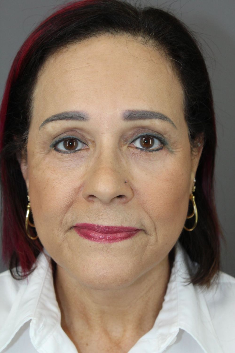 Botox Before & After