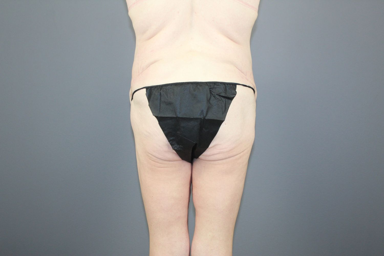 Surgery After Weight Loss Before & After