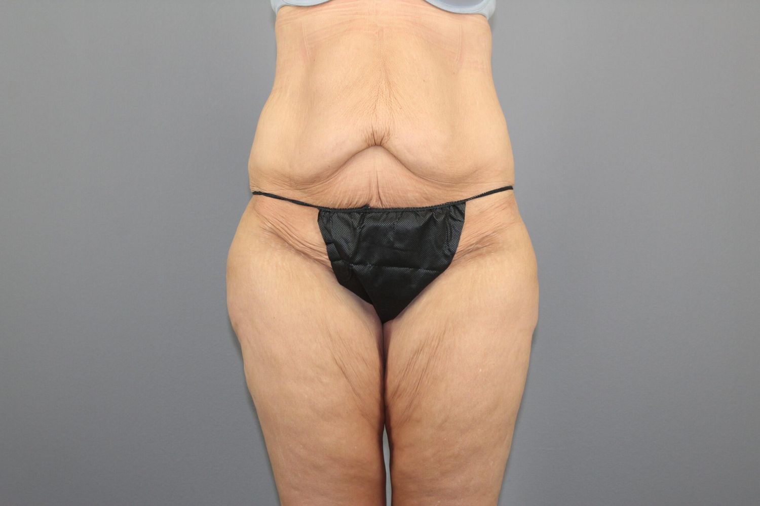 Surgery After Weight Loss Before & After