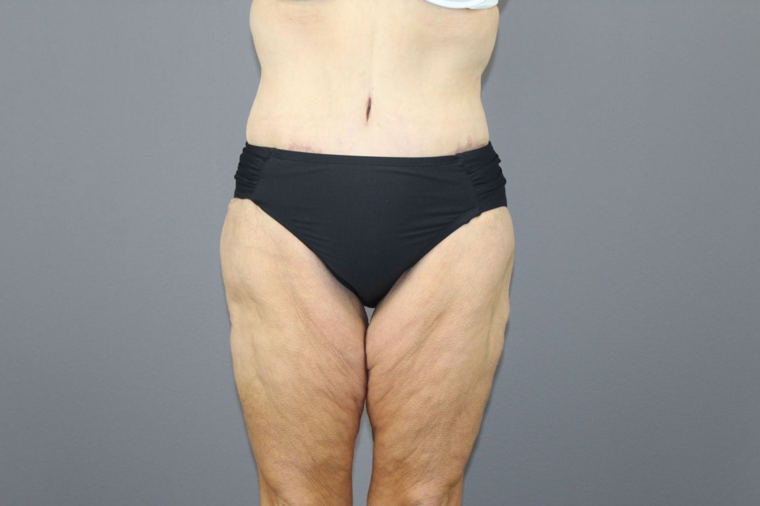 Surgery After Weight Loss Before & After