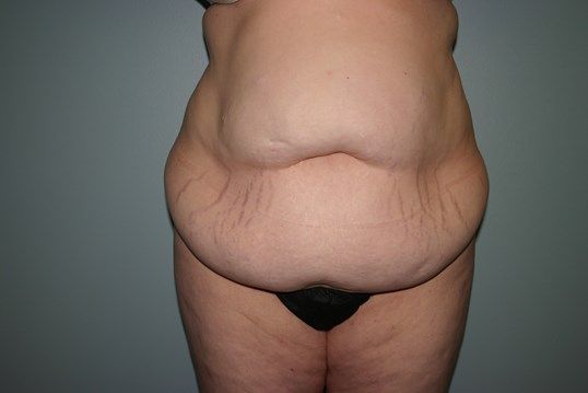 Surgery After Weight Loss Before & After