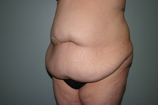 Surgery After Weight Loss Before & After